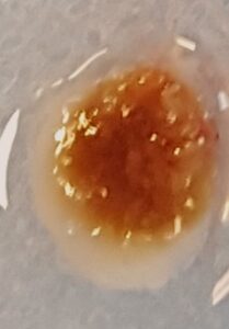 Cataracte dure: cristallin post extraction complète